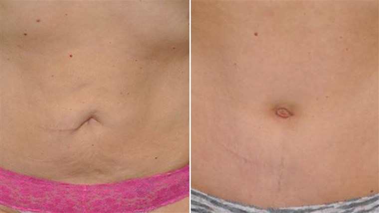 Innan and after belly button surgery