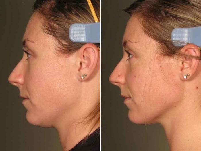 Ultherapy: Reviews & Cost Before & After Pictures