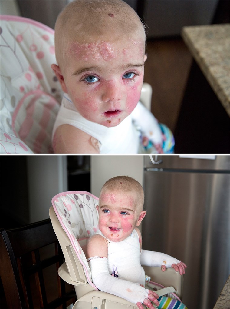 17-månader gammal Elisa McCann is living with Epidermolysis Bullosa, a rare and debilitating skin disease. Her condition has been rapidly improving after s...