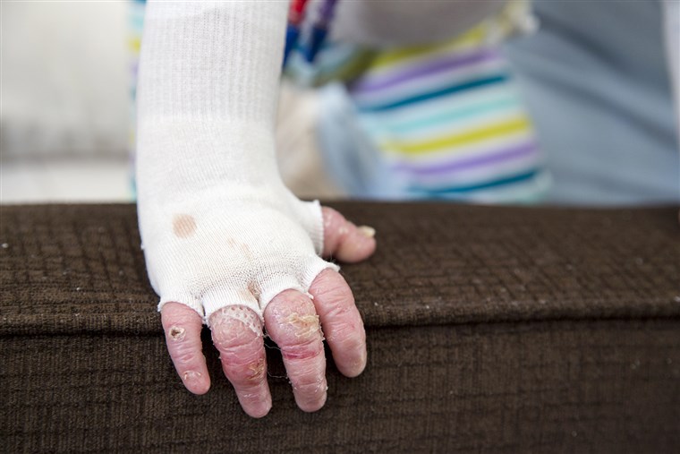 17-månader gammal Elisa McCann is living with Epidermolysis Bullosa, a rare and debilitating skin disease. Her condition has been rapidly improving after s...