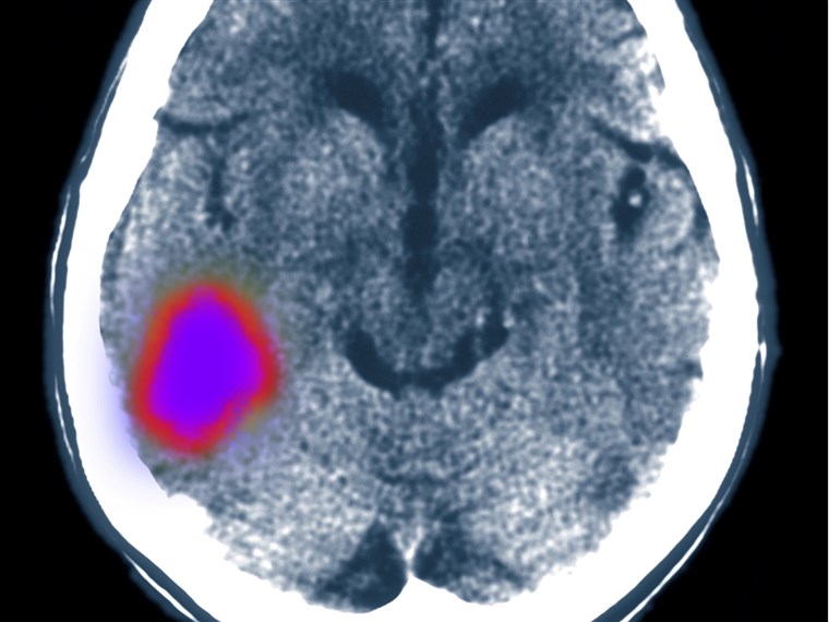 Церебрал CT scan showing stroke