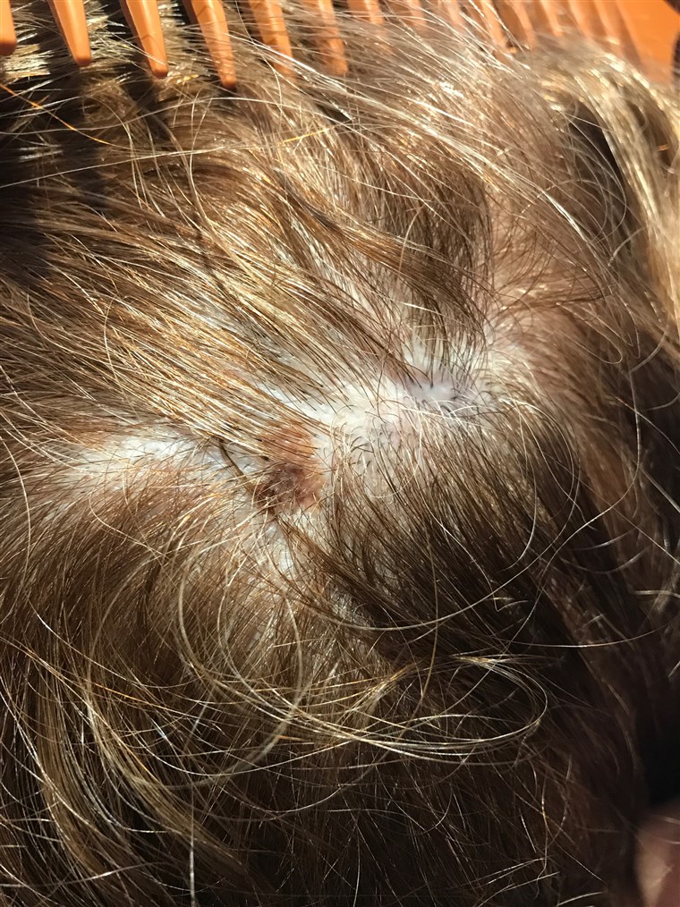 Cand Eileen Korey was getting her hair colored, her stylist, Kari Phillips noticed a new spot on Korey's head. She took a picture, which encouraged Korey to see her doctor, when Korey learned it was melanoma.