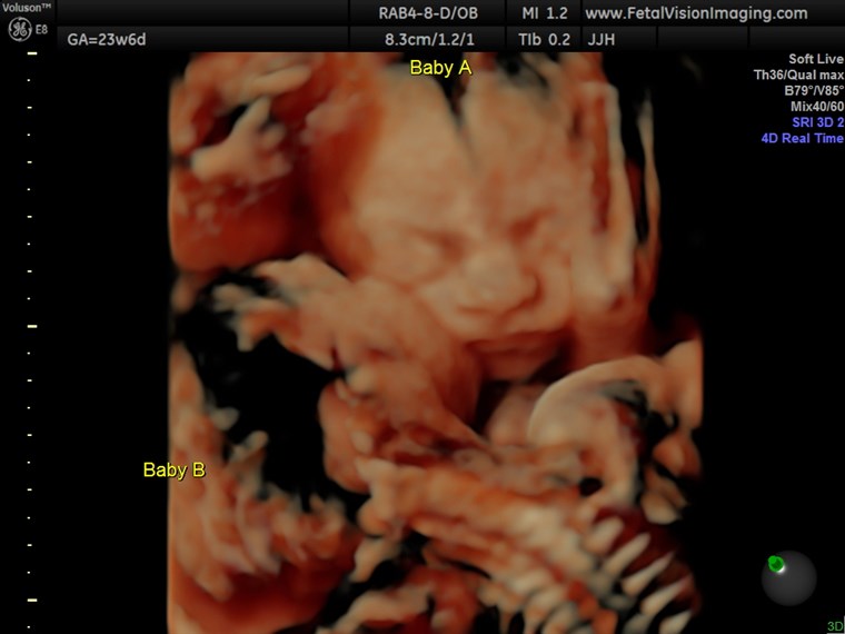tvillingar kissing in ultrasound photo