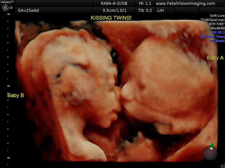Bebelus twins kissing in the womb ultrasound