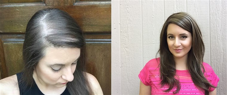 Lauren Engle experienced hair loss in her 20s.